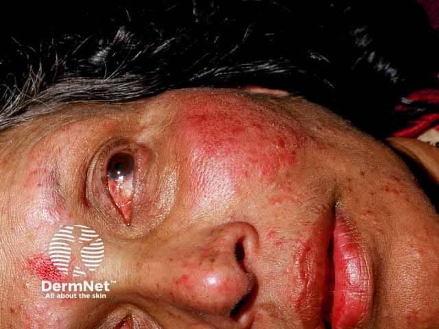 Clinical photography of the face, frontal close-up, high-resolution. Anatomical region: central facial skin including cheeks, nasal dorsum, perioral area, and periocular tissues. Primary subject: papulopustular rosacea with ocular involvement. Appearance: diffuse erythema of the central face with a constellation of inflammatory papules and pustules scattered across the malar region and nose; mild telangiectasia along the cheeks; lips and surrounding skin show no ulceration. Periocular redness and lid-margin irritation are present, compatible with ocular rosacea; eyelids appear mildly edematous without obvious keratitis in this image. Skin texture shows slight roughness and residual flaking. The overall pattern is chronic inflammatory facial dermatitis centered on the midface, rather than acne conglobata or lupus. Diagnostic significance: classic papulopustular rosacea with probable ocular involvement; warrants ophthalmology referral to assess ocular surface, blepharitis, and potential corneal involvement; informs systemic versus topical therapy decisions. Differential considerations: acne vulgaris (less likely distribution), steroid-induced rosacea, seborrheic dermatitis, lupus erythematosus mimicking rosacea, contact dermatitis. Clinical relevance: important for educational purposes, differential diagnosis of facial erythema, guiding treatment planning (topical metronidazole/azelaic acid, doxycycline in adequate dosing, eyelid hygiene) and patient counseling on triggers and chronicity. This image illustrates rosacea heterogeneity and emphasizes the need for multidisciplinary management. Guides comprehensive patient care.