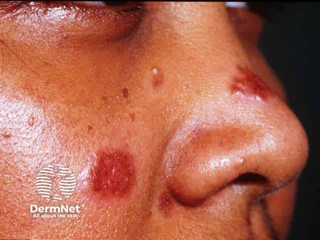 High-resolution clinical photograph of facial skin showing cutaneous sarcoidosis presenting as erythematous-violaceous plaques. The dominant lesion is a well-demarcated, indurated plaque on the cheek with a smaller plaque near the nasal sidewall/bridge. Surfaces appear relatively smooth with minimal scaling and firm, slightly raised borders. Coloration ranges from deep red to purple with subtle gloss; margins are distinctly defined, and the surrounding skin shows mild edema without obvious ulceration. The distribution is central on the midface, involving malar region and nasal area, with unilateral predominance. This image captures typical morphological features of cutaneous sarcoidosis, where granulomatous inflammation produces compact, noncaseating granulomas in the dermis. The imaging modality is clinical photography using a close-up macro lens to maximize color fidelity, border delineation, and lesion texture. Clinically, facial sarcoidosis raises suspicion for systemic involvement; thus, findings should prompt further evaluation for extrafacial sarcoidosis (pulmonary, ocular, lymphatic). Differential diagnoses include granulomatous rosacea, lupus vulgaris, necrobiosis lipoidica diabeticorum, and other granulomatous dermatoses. Knowledge of plaque morphology aids dermatology and pathology training, supports case-based discussion, and enhances databases for AI-assisted recognition of sarcoid skin lesions. This image is suitable for educational, diagnostic, and research applications in dermatology.