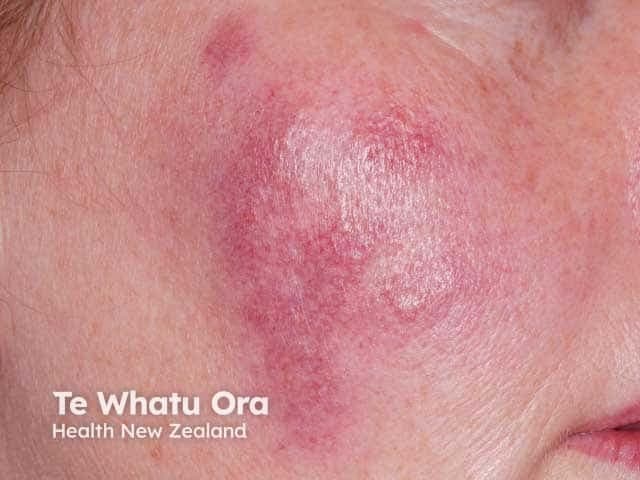 This is a high‑resolution clinical photograph of a single violaceous cutaneous plaque on the malar/cheek region. Imaging modality: clinical photography of the skin, near-frontal view of the zygomatic area under white light, without dermoscopic enhancement. Anatomical localization: integumentary system, facial skin; cheek. Visual features: a well‑circumscribed, indurated plaque with a purple‑violaceous hue, smooth to slightly glossy surface, mild surrounding erythema, and subtle texturing. The lesion geometry is oval to irregular, with a slightly lighter center suggesting mild central atrophy or edema. Medical impression: the violaceous, persistent plaque on the face is highly suggestive of cutaneous sarcoidosis presenting as lupus pernio, a prototypical cutaneous manifestation linked to systemic sarcoidosis. Alternative considerations include granulomatous rosacea, chronic infectious granulomas (mycobacterial or fungal), and other granulomatous dermatitis. Diagnostic significance: if lupus pernio is suspected, correlate with chest imaging, serum ACE levels, and biopsy showing noncaseating granulomas for confirmation. Clinical relevance: this morphology warrants multidisciplinary evaluation for systemic involvement, and consideration of dermatology, pulmonology, and rheumatology follow‑up. Potential clinical use: educational reference for dermatology training, sarcoidosis recognition, and differential diagnosis practice with facial violaceous plaques. In documentation, annotate lesion margins, color, and texture changes over time to assist monitoring and therapeutic response assessment and prognosis.