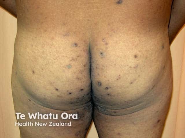 Imaging modality: Dermatologic clinical photograph; Technique: Standard color photography with even lighting; The image captures the bilateral gluteal region from a posterior perspective. Numerous small, dark-brown to violaceous nodules and papules are scattered across the buttocks, extending into the intergluteal fold. Lesions are discrete, well-circumscribed, dome-shaped, and firm on palpation, with no apparent ulceration. Distribution is bilateral and predominantly involves gluteal skin, with occasional spread toward adjacent posterior thighs. Morphology features include nodular/papular texture, surface hyperpigmentation in darker skin tones, and subtle shading around lesion margins. The clinical impression is nodular scabies on the buttocks, consistent with a hypersensitivity reaction to Sarcoptes scabiei infestation. This pattern complements classic burrow lines in other body areas, though burrows may be sparing in this region. The image is educational for dermatology and infectious diseases, illustrating scabies-associated nodules as a chronic, non-vesicular eruption. Relevance spans differential diagnosis with dermatitis, prurigo nodularis, folliculitis, and insect bites, and supports clinical correlation with pruritus history, exposure risk, and household contact tracing. Potential clinical use cases include tele-dermatology assessment, treatment response monitoring, patient education, and public health screening during scabies outbreaks. The image thereby serves as a reference for nodular scabies located on gluteal skin.