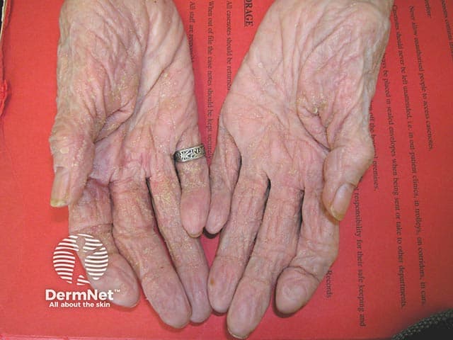 This entry is a high-resolution clinical photograph of bilateral palmar skin illustrating early crusted scabies (Norwegian variant) on palms. Modality: clinical photography; technique: frontal palmar view, close-up capture, natural lighting; specimen: human palmar epidermis with thick hyperkeratotic crusts; anatomical localization: volar surfaces of the hands, including interdigital folds; imaging perspective: anterior exposure, head-on view. Visual features: extensive hyperkeratotic crusting, parchment-like scales, fissuring along palmar creases, mild erythema, and diffuse dryness; there is marked crusted plaque formation with irregular margins, more prominent on thenar and hypothenar eminences. Pathology: infestation by Sarcoptes scabiei var. hominis manifested as crusted scabies; clinical correlate with high mite burden; risk of secondary bacterial infection. Diagnostic significance: hallmark of crusted scabies; highly contagious; necessitates isolation, contact tracing, and prompt antiparasitic therapy (permethrin, ivermectin) and wound care; monitor for secondary infection; educate patient and household contacts. Potential clinical use cases: dermatology teaching, infectious disease illustration, rapid bedside recognition, differential diagnosis workflow for diffuse palm crusting; differential includes eczema, psoriasis, tinea manuum, palmoplantar keratoderma. Synonyms: Norwegian scabies, crusted scabies; keywords: palms, hand dermatosis, hyperkeratosis, crusted lesions, skin infection risk. Consider concomitant bacterial superinfection management and patient education on transmission prevention and skin hygiene. Follow-up recommended after therapy.