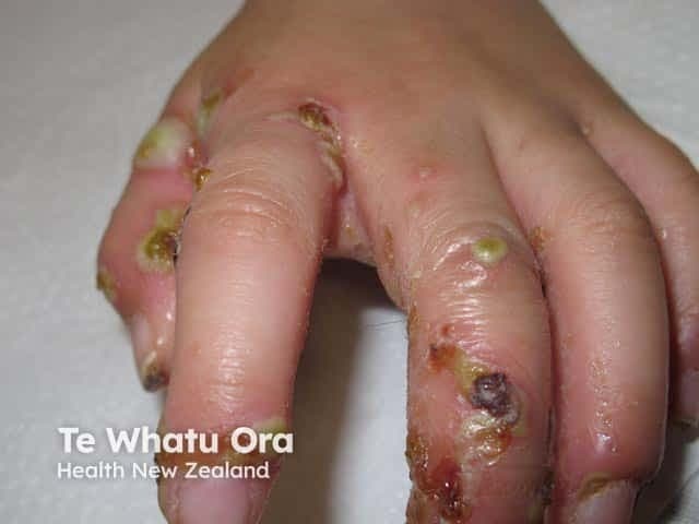 Clinical photograph of the dorsum and interdigital surfaces of the hand demonstrating extensive crusted skin lesions with yellow-brown crusts, eroded margins, and surrounding erythema. The appearance is characteristic of crusted (Norwegian) scabies with superimposed bacterial infection; in this case the crusts and purulent debris are more accentuated by a secondary pyococcal infection. Numerous discrete plaques are distributed across several digits, including the proximal and middle phalanges, with fissuring in interdigital spaces. In addition to crusts, there are vesicles or pustules and areas of tissue breakdown, suggesting active inflammation and possible secondary necrosis. The overall picture emphasizes a high infectious burden and contagiousness, requiring urgent dermatologic and infectious disease management. The clinical relevance includes recognizing crusted scabies as a risk factor for disseminated bacterial colonization and sepsis if untreated. Management implications entail combination therapy with specific scabicides (permethrin cream, ivermectin) and broad-spectrum antibiotics active against Pseudomonas aeruginosa or equivalent pyogenic organisms; strict contact precautions are advised in clinical settings. The image provides educational value for diagnosing crusted scabies, secondary impetigo, and differential diagnoses such as eczema with crusting or bullous impetigo, and supports teaching on infection control, wound care, and outpatient vs inpatient management.
