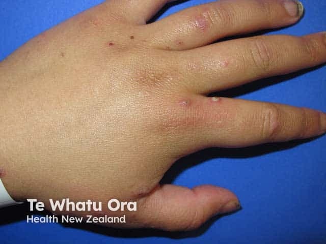 A high-resolution clinical photograph captures the dorsum of the hand demonstrating scattered pustular papules and small erosions on an erythematous base. The image was acquired using clinical photography in visible light with a neutral background to ensure color fidelity; no contrast agents or staining were used. The primary anatomical focus is the skin of the dorsal hand, including the metacarpal dorsum and interdigital spaces. Pustules are nonfollicular, approximately 2–4 mm in diameter, with surrounding mild erythema and shallow crusts, consistent with secondary bacterial infection superimposed on a scabies eruption. The appearance is compatible with infected scabies (scabies with impetiginization) and may show superficial crusting or pustulation at burrow sites. Clinically significant features include pruritus, linear burrows that may be subtle, and a crusted/pustular infestation pattern. Diagnostic significance lies in identifying secondary infection that necessitates antibiotic therapy (e.g., anti-staphylococcal coverage) in addition to scabicidal treatment. This image is valuable for dermatology education, clinical case repositories, and differential diagnosis training (impetigo, eczema herpeticum, papular urticaria). Potential use cases include teledermatology consultations, image-based teaching modules, and research on mite-related skin lesions and superinfection dynamics.