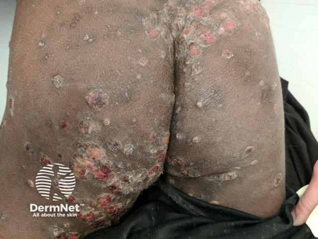 Clinical photograph of the buttocks and gluteal region showing multiple firm nodules with ulceration and crusted surfaces against dark skin. The lesions are localized to the intergluteal and perineal skin extending over the buttock folds, with surrounding erythema and excoriation. The nodules are erythematous-to-brown, dome-shaped, some with central pits or shallow ulcers, and overlying crusts consistent with secondary bacterial infection. The appearance is typical for nodular scabies in which the inflammatory nodules result from a host hypersensitivity reaction to Sarcoptes scabiei antigens. Crusting, scale, and fissuring are evident, indicating chronic scratching and secondary impetiginization. Notable features include clustered lesions, bilateral symmetry on the buttocks, and variable depth of ulceration; there may be surrounding edema in some areas. This image emphasizes cutaneous scabies manifestations beyond classical burrows, highlighting nodular scabies as a pruritic, proliferative eruption that can be misdiagnosed as dermatitis or folliculitis. Diagnostic significance lies in recognizing nodular scabies with secondary infection to guide therapy: topical scabicide (permethrin 5%), systemic ivermectin if extensive, and antibiotics for secondary infection. Potential clinical use cases include dermatology education, differential diagnosis exercises for nodular scabies, telemedicine consultations, and competency assessment of recognition of scabies-related skin lesions in darkly pigmented skin. The image supports teaching about disease manifestations, treatment implications, and infection control measures.