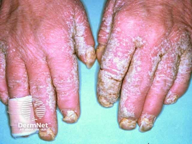 Imaging modality: Clinical photography of the hands, high-resolution frontal view capturing dorsal and palmar surfaces and both nails. The scene shows bilateral, symmetric involvement of the hands with thick, adherent crusts over erythematous, fissured skin. On the dorsal and palmar surfaces, extensive hyperkeratotic plaques exhibit chalky to yellow-white crusts, scale, and superficial erosions. Nails demonstrate dystrophy characterized by thickening, onycholysis, and irregular plate contour; periungual involvement is evident. The morphology is consistent with crusted (Norwegian) scabies, a high-burden infestation by Sarcoptes scabiei, often seen in immunocompromised or elderly hosts and associated with heavy mite burden and high contagion risk. The photograph highlights the diagnostic relevance of cutaneous involvement in crusted scabies and underscores potential secondary infections. Notable differential considerations include chronic dermatitis, psoriasis with nail changes, and tinea manuum; however, the presence of dense crusting with nail dystrophy in both hands favors crusted scabies in the appropriate clinical context. This image is clinically valuable for education and reference in dermatology, infectious disease, and hand diseases; useful in teaching crusted scabies recognition, infection control imperatives, and triage for rapid, combined systemic and topical therapy. Clinically, this dataset supports rapid retrieval for case-based learning, differential diagnosis discussions, and imaging-based diagnostic pattern recognition for scabies crusted infestations.