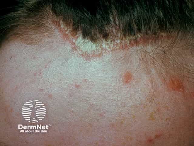 Clinical photography of the scalp and frontal hairline illustrating a clear plaque psoriasis lesion. Modality: clinical color photograph; frontal/anterior view focused on the forehead and perihairline skin. Primary subject: an erythematous, well-circumscribed plaque with coarse, adherent scale arising at the anterior hairline and extending forward onto the forehead. Color is orange-red with silvery-white scale at the margins, demonstrating classic plaque morphology. The lesion is well demarcated from adjacent nonlesional skin, with mild surface desquamation and subtle surrounding erythema. Hair-bearing scalp adjacent skin shows dry, fine scale; no secondary lesions are evident in this field. The image captures typical psoriasis features: sharply demarcated edge, plaque elevation, and hyperkeratosis. This supports a clinical diagnosis of plaque psoriasis involving the scalp and frontal scalp/forehead region; differential diagnoses include seborrheic dermatitis, atopic dermatitis, tinea capitis, candidiasis, and irritant contact dermatitis. The diagnostic significance lies in recognizing chronic plaque psoriasis pattern, guiding topical therapy with corticosteroids, vitamin D analogs, or coal tar preparations, and prompting evaluation for additional site involvement. Clinically correlates with pruritus, flaking, and potential Koebnerization; useful for education, documentation, and treatment monitoring in dermatology research and medical education. This image serves as an educational reference for residents and students studying plaque psoriasis morphology on the hairy scalp.