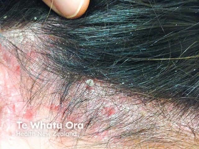 Clinical photograph of the scalp and posterior neck demonstrating active psoriasis vulgaris with scalp involvement extending to the nuchal (occipital) region. Imaging modality: noninvasive dermatologic photography; technique: wide-field, non-magnified view under standard lighting. The primary subject is human skin within the scalp dermatome area and neck, featuring erythematous plaques with finely adherent silvery-white scales, variable plaque thickness, and marginal scaling at the hairline. Notable features include well-demarcated, raised erythema, diffuse desquamation, and minimal excoriation in exposed areas. The lesions appear on the vertex and temporal regions as well as the posterior scalp transitioning to the occipital neck, consistent with psoriatic plaque morphology. From a diagnostic standpoint, these findings are characteristic of psoriasis vulgaris involving the scalp, with potential involvement of the nuchal region; differential diagnoses include seborrheic dermatitis, tinea capitis, eczema, and lichen planus. Clinically, the image underscores the importance of recognizing psoriasis in hair-bearing areas due to treatment implications (topical corticosteroids, vitamin D analogs, coal tar preparations, or phototherapy) and possible assessment for psoriatic arthritis in long-standing disease. This image is relevant for clinical education, dermatology research, and narrative case assist in medical literature reviews and teaching modules. It supports diagnosis, therapy planning, and patient education resources for clinicians.