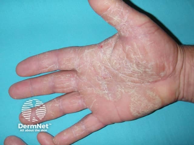 This clinical photograph documents a palmar dermatitic pattern characterized by diffuse xerosis with hyperkeratotic scales on the palmar surfaces of the hand. The epidermis shows thickened, white, scaly plaques concentrated along the mid- and thenar/hypothenar regions and intermetacarpal folds. Fine fissuring is present at several palmar creases, and the skin texture is rough with reduced pliability. The dorsum of the hand appears relatively unaffected. There is mild erythema absent or minimal, and no vesiculation or purpura is seen. The pattern is compatible with chronic hand dermatitis (eczema) or palmoplantar hyperkeratosis; psoriasis could mimic this presentation but typically features thicker plaques with erythema and more silvery scales, whereas eczema shows dryness, fissuring, and scaling. Secondary infection is not evident. The image highlights the importance of emollient-based therapy, barrier restoration, and topical anti-inflammatory agents in management. This image could be used to illustrate palmar eczema in dermatology education, serve as a reference for differential diagnosis in hand dermatoses, and support treatment response monitoring in clinical practice. It is relevant for teledermatology consultations and research on palmar skin diseases.
