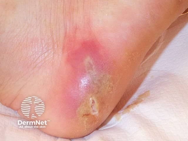 Clinical photograph of acute cellulitis involving the soft tissues of the foot/ankle. Acquisition: high-magnification, close-up dermatologist’s view, not a radiologic modality. The image shows a localized erythematous, warm, and tender plaque with surrounding edema on the plantar-lateral aspect of the foot near the ankle. The skin surface is glossy with mild desquamation and a small crust or erosion at the lesion margin, consistent with superficial disruption. No obvious purulence is visible in this frame, but the erythema extends beyond the edge of the lesion, suggesting active inflammatory infiltration of the dermis and subcutaneous tissue. This appearance aligns with cellulitis rather than dermatitis, erysipelas, or venous stasis changes, though mimics may include contact dermatitis. Key features include abrupt onset, focal swelling, heat, and tenderness, supporting a bacterial etiology typically caused by streptococci or staphylococci. Clinically, this finding warrants prompt antibiotic therapy and evaluation for systemic involvement. When differentiating from abscess, necrotizing fasciitis, or deep-seated infection, consider imaging or ultrasound if signs of abscess or rapid progression arise. Document exposure history, diabetes or edema, and immunocompromise status. This image is suited for dermatology education, infectious disease training, and clinical decision support databases, illustrating surface dermatologic signs that guide triage and therapeutic choices.