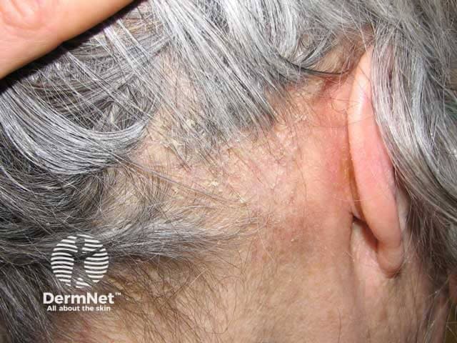 Clinical photography of the scalp demonstrating seborrhoeic dermatitis with thick adherent scales. The image presents a macroscopic view of the left temporal scalp and retroauricular region. Specimen type: human scalp skin. Imaging perspective: close-up, lateral scalp with ear visible. The scales are thick, greasy, yellowish, lamellate, coating the scalp surface and obscuring underlying hair shafts. Surrounding skin shows mild erythema and minimal crusting; hair density is preserved; no ulceration. This pattern is characteristic of seborrhoeic dermatitis: chronic relapsing inflammatory dermatosis associated with Malassezia yeast, sebaceous gland activity, and host inflammatory response. The lesion displays confluent plaques with adherent scale, diffuse but more prominent in chronically affected areas such as the temporal and retroauricular scalp. Diagnostic significance: photographic documentation aids clinical diagnosis, guides topical antifungal or anti-seborrheic therapy, and serves as baseline for response assessment. Differential considerations include psoriasis capitis (more silvery scale and well-demarcated plaques), tinea capitis (alopecia, hair shedding, broken hairs), and contact dermatitis. Clinical correlation includes pruritus, oiliness, and seasonal flares. This image is useful for education, dermatology training, and image-based search queries for seborrheic dermatitis of the scalp. Images like this support differential diagnosis, treatment planning, and educational demonstrations for medical students, residents, and clinicians in clinics.