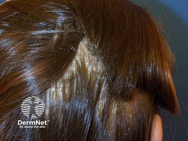 Comprehensive Description: This is a high-resolution clinical photograph of the scalp taken in vivo, using standard dermatology photography techniques, showing a lateral (side) view of the hair-bearing skin. The image demonstrates extensive seborrhoeic dermatitis with overlapping greasy scales adherent to erythematous plaques over the scalp, most prominently along the temporal and vertex regions. The scales appear yellowish-white, oily in appearance, and coalesce to form layered flakes that extend into the hair margins. Mild diffuse erythema and scaling are present without visible purpura or crusting. Hair remains present, with no obvious scarring alopecia. The morphology is consistent with inflammatory dermatosis of the scalp; differential diagnoses include psoriasis capitis, tinea capitis, and atopic dermatitis, though the greasy character with fine lamellar scaling favors seborrheic dermatitis. Clinically, this image is relevant for dermatology education, trichology assessment, and differential diagnosis practice, as well as for evaluating treatment response to antifungal shampoos (ketoconazole, head-and-shoulders zinc pyrithione), corticosteroid, or calcineurin inhibitor regimens. It can be used in teaching modules on scalp dermatoses, in digital archives for image-guided diagnosis, and for research into Malassezia-associated inflammation, inflammatory skin disorders, and patient counseling on scalp hygiene. This descriptor supports retrieval in education, clinical case review, and dermatology datasets globally.