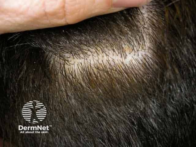 Clinical photograph of the scalp demonstrates seborrhoeic dermatitis characterized by honey-coloured, greasy scales adherent to hair shafts with mild surrounding erythema. Involvement is patchy to diffuse over hair-bearing skin, most pronounced at the vertex and temple regions, with scales accumulating along follicular openings. The yellowish scales are waxy and easily removable, yet can be persistent; pruritus is commonly reported in patients. Hair shafts appear preserved and no frank alopecia is evident in this image. This presentation aligns with the typical clinical phenotype of seborrhoeic dermatitis, a common inflammatory scalp dermatosis linked to sebaceous gland activity and colonization by Malassezia species. The visual features help distinguish it from psoriasis (silvery scales, well-demarcated plaques) and tinea capitis (hair loss, broken hairs, erythematous patches). Diagnostic significance lies in recognizing the greasy, yellow scales on the scalp as a hallmark, guiding topical therapies such as selenium sulfide, zinc pyrithione, ketoconazole antifungal shampoos, and low‑potency corticosteroids when appropriate. Clinically, the image is relevant for dermatology education, differential diagnosis exercises, and treatment response documentation in adult and pediatric patients. The image supports hands-on recognition of seborrhoeic dermatitis patterns in scalp dermatology curricula and serves as a reference for teledermatology consultations.