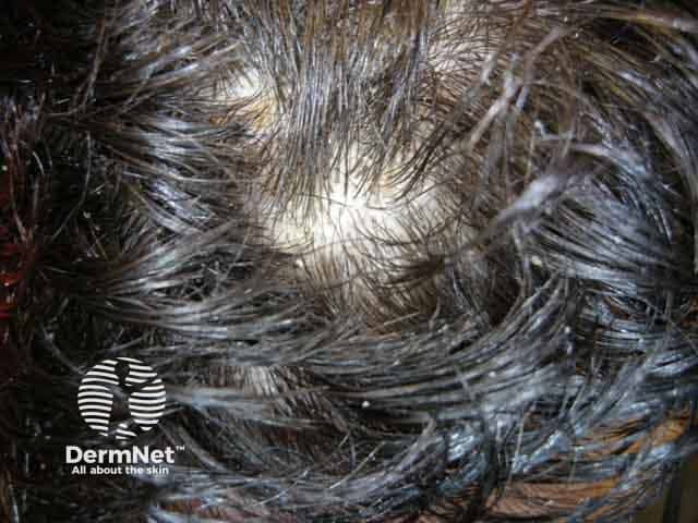 Clinical photograph of the scalp depicting seborrheic dermatitis with visible scales and dandruff. Modality: clinical photography; technique: standard bright-light macro close-up; magnification approximately 1.5–2x. Anatomic location: hair-bearing skin of the scalp (vertex and frontal regions), with erythematous, inflamed surrounding skin and greasy yellowish-white scales adherent to hair shafts and interfollicular zones. Visual features include diffuse flaking, oily sheen, crusting at hairline, and punctate erythema beneath flaking areas. The scale is fine to moderately thick, loosely adherent to microscopic hair shafts, often described as dandruff in milder cases. The image captures typical seborrheic dermatitis morphology: erythematous plaque-like patches with greasy scales, preferentially in sebaceous-rich regions, sometimes involving eyebrows and the glabella. Pathological correlation: clinically arcuate to patchy inflammation with hyperseborrhea; Malassezia yeast and lipid-rich microenvironment contribute to flaking. Diagnostic significance: supports diagnosis of seborrheic dermatitis; helps differentiate from dry scalp, psoriasis, or tinea capitis; guides therapeutic decisions. Potential clinical use cases include documentation of disease severity, patient education about chronic relapsing course, and evaluation of treatment response to antifungal shampoos (ketoconazole, zinc pyrithione) and anti-inflammatory agents (low-potency steroids, calcineurin inhibitors). When in doubt, correlate with symptoms such as pruritus, distribution, and presence of associated conditions (facial seborrhea, dandruff).