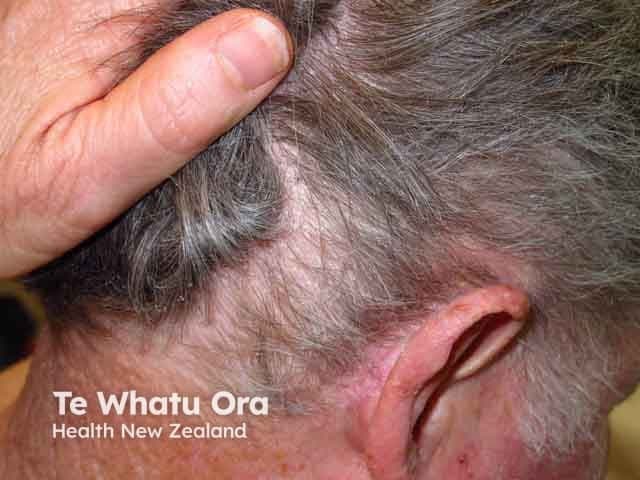 Clinical photography of the left retroauricular skin region demonstrates classic features of seborrhoeic dermatitis. The image shows erythematous, plaque-like patches with greasy, yellow-white scaling along the postauricular sulcus and adjacent scalp margins. The surrounding skin is mildly inflamed, with fine desquamation and mild edema; hair-bearing skin in the temporal area appears unaffected or variably involved. No secondary bacterial infection or crusting is evident. The appearance is symmetrical with typical sebaceous-rich distribution, reflecting fungal lipid degradation products and inflammatory response to Malassezia species. The lesion margins are relatively well defined, and the coloration ranges from pink to salmon with golden-scale overtones. Pruritus may be present but is not clearly depicted in the still image. This presentation can extend to the behind-ear fold, scalp margins, and forehead in a seborrheic distribution. Clinically, this condition is benign but relapsing, often coexisting with scalp dermatitis or dandruff. Differential diagnoses include tinea (dermatophyte) infections, psoriasis in seborrheic areas, contact dermatitis, and less likely atopic dermatitis. Management typically involves topical antifungals (ketoconazole, ciclopirox), anti-inflammatory agents (low-potency corticosteroids or calcineurin inhibitors), and regular hygiene to reduce sebaceous load. Documentation of this retroauricular dermatitis supports diagnosis and guides targeted therapy, monitoring response and relapse potential in dermatology practice.