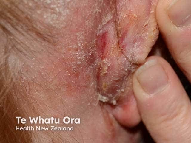 Comprehensive Description: A high-resolution clinical photograph captures the retroauricular skin behind the ear on an adult patient. The image demonstrates erythema and scale with crusted, greasy plaques localized to the posterior auricular region. The skin shows focal desquamation with lamellar white scales adherent to the lesion edges; surrounding skin appears mildly dry with faint erythema. There is no visible purulence, ulceration, or vesiculation. The distribution is localized to the retroauricular fold, consistent with seborrhoeic dermatitis involving sun-exposed or sebaceous-rich areas; reflectivity of the skin appears slightly oily, with fissuring minimized by moisture. The appearance is characteristic of chronic inflammatory dermatosis in adults, often presenting bilaterally on the scalp, eyebrows, nasolabial folds, and behind-ears. In this image, the retroauricular involvement aligns with typical patterns described for seborrheic dermatitis, as opposed to psoriasis or contact dermatitis, which may show more scaling, well-defined plaques, or vesiculation. The clinical context suggests a benign chronic inflammatory process related to Malassezia yeast overgrowth and sebaceous gland activity; the lesion responds to antifungal or anti-inflammatory therapy. This image is useful for dermatology education, differential diagnosis practice, and documentation of retroauricular SD for clinician reference and patient education.