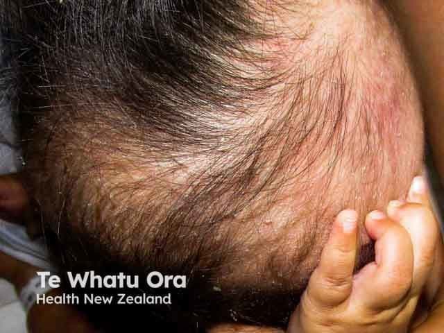 This is a high-resolution clinical photograph of an infant scalp demonstrating seborrhoeic dermatitis with yellow greasy scales preferentially located on the frontal/temporoparietal scalp and sparing the face. The image captures the characteristic matting and flaking scales adherent to hair shafts, with mild erythema and diffuse scale accumulation at the crown and temple regions. The lesion is non-vesicular, non-exudative, and appears symmetrical across the scanned scalp area. The findings are consistent with cradle cap, a common, benign dermatologic condition of infancy believed to reflect sebaceous gland activity and infant skin immaturity. Differential considerations include tinea capitis if alopecia or perifollicular scaling is prominent, atopic dermatitis with more diffuse erythema, or psoriasis with well-demarcated plaques though these are less typical in early life. Clinically correlated, this pattern typically responds to routine infant scalp hygiene and gentle, non-irritating cleansing; medicated soaps or antifungal shampoos may be used under pediatric guidance if scales persist. This image is valuable for educational reference in pediatric dermatology, dermoscopy correlation not shown, and radiology cross-disciplinary discussions about differential diagnoses of scalp scaling. Potential applications: medical education, image-based differential diagnosis training, clinical case discussions, and telemedicine triage for infants presenting with cradle cap.