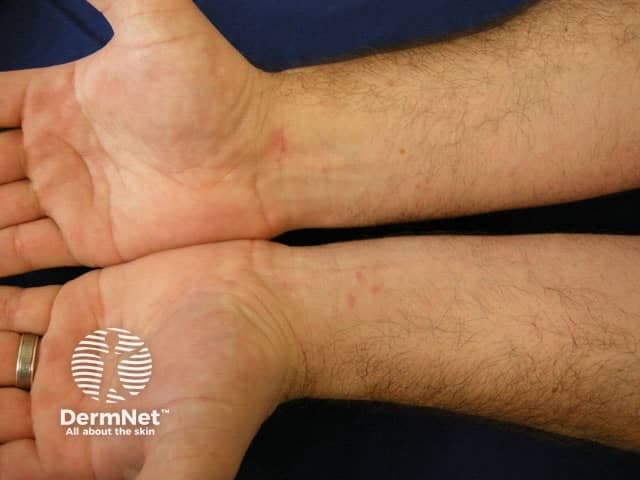 Clinical photography of bilateral wrists demonstrating classic cutaneous lichen planus. In vivo skin image documenting the palmar/flexor surfaces of the wrists with low to moderate magnification. Primary subject: violaceous, flat-topped papules arranged in a symmetric, polygonal pattern along the flexor aspects. The lesions exhibit a glossy, slightly scaly surface and subtle Wickham’s striae in some areas; pruritus is often present but not uniformly required for diagnosis. The distribution is predominantly on the wrists with potential mild edema or erythema at lesion margins. The overall appearance is briskly ink-purple to brown-purple, with well-defined borders and a tendency to coalesce into plaques over time. There is no obvious mucosal involvement in this image. This photograph supports the clinical diagnosis of lichen planus by morphology and anatomical distribution, aiding differentiation from psoriasis, eczema, pityriasis rosea, and tinea infections. Relevant features for search include lichen planus, violaceous papules, flat-topped papules, Wickham lines, wrists, flexor surfaces, bilateral distribution, dermatology photography, clinical dermoscopy correlation not shown. This image is primarily for educational and diagnostic reference, enabling clinicians and trainees to recognize typical cutaneous LP patterns, document treatment response, and correlate with histopathology in uncertain cases. Thanks.