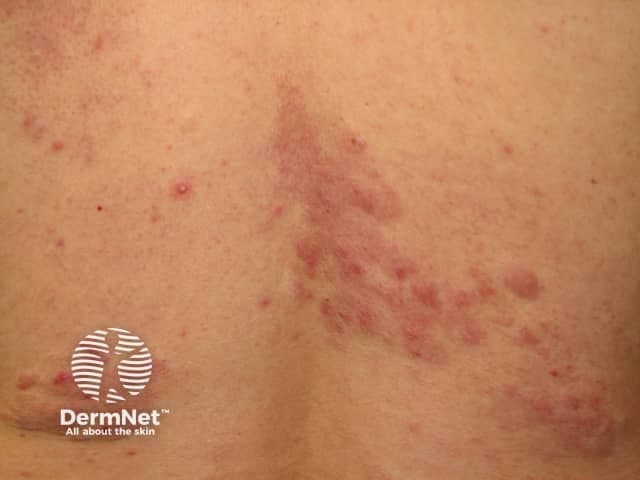 Clinical photography of a shagreen patch on the lower back illustrating a leathery, pebbled dermal plaque consistent with a connective tissue nevus. The lesion is located in the lumbosacral region of the posterior trunk. It presents as a gray‑brown, rough-surfaced plaque with irregular margins and a tactilely rugged texture, often described as resembling sharkskin or orange-peel. This cutaneous stigmata of tuberous sclerosis complex results from locally thickened dermal collagen with disorganized, dense bundles and reduced elastic fibers. Histopathology (when biopsied) shows a dense, haphazard dermal collagen matrix without cellular atypia, confirming a collagenoma phenotype characteristic of shagreen patches. Clinically, shagreen patches are harbingers of TSC and carry diagnostic significance; their presence reinforces consideration of CNS involvement (cortical tubers, subependymal nodules) and warrants comprehensive neurologic and genetic evaluation. Differential considerations include other connective tissue nevi (collagenomas) and elastin-rich nevi, but the constellation with hypomelanotic macules and facial angiofibromas strengthens the TSC diagnosis. This image serves educational and diagnostic contexts for dermatology, medical genetics, and radiology cohorts, illustrating lesion morphology, location, and relevance to systemic disease.