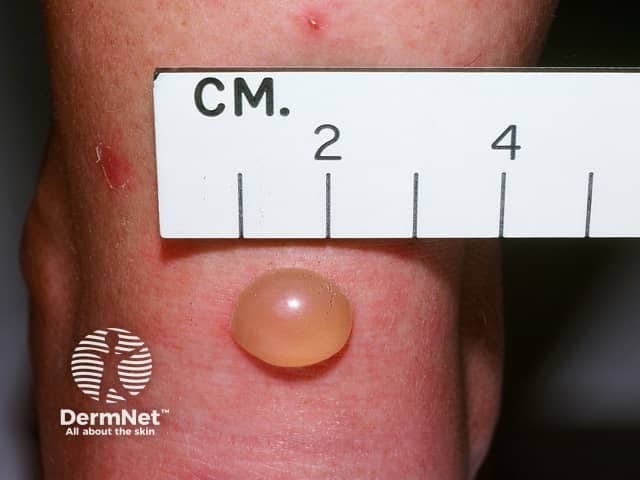 Clinical macroscopic photograph of a solitary cutaneous lesion consistent with an insect bite reaction. Imaging modality: clinical photography with macro close-up, frontal view, ambient lighting; magnification approximately 1.5–2x. Anatomical location: skin of the forearm/wrist region (integumentary system, skin). The lesion is a single, dome-shaped, translucent to skin-colored vesicle/bulla measuring roughly 6–8 mm in diameter, with a smooth, shiny surface and minimal surrounding erythema. The lesion is nonulcerated and without crusting or purulence, suggesting a vesicular blister rather than pustular infection. Clinically, this morphology is typical of a localized insect bite reaction (mosquito, biting fly, or bee) with rapid onset after exposure; differential diagnoses include vesicular contact dermatitis, bullous impetigo, and less likely herpes simplex or varicella zoster vesicles in a solitary focal location. Diagnostic significance lies in recognizing a benign, self-limited cutaneous response requiring symptomatic care and surveillance for secondary infection. Potential clinical use cases include dermatology education, teledermatology triage, image-guided wound assessment, AI-based lesion classification, research on bite reactions, patient counseling, and educational resources for medical students and clinicians.