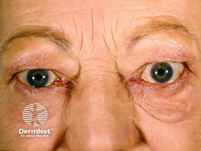 Imaging modality and technique: Clinical frontal photograph of the orbits and periorbital region in a living adult patient. Frontal view capturing both eyes demonstrates bilateral exophthalmos with mild periorbital edema and eyelid swelling. The ocular surfaces are visible with subtle scleral exposure and conjunctival vascularity not markedly prominent in this image. Anatomical localization centers on the orbital contents including extraocular muscles and orbital fat, with involvement of eyelids and periorbital soft tissues. The appearance is most consistent with thyroid ophthalmopathy (Graves’ orbitopathy), a form of autoimmune orbital inflammatory disease associated with hyperthyroidism or autoimmune thyroiditis. Pathophysiology involves infiltration and edema of orbital connective tissues and extraocular muscles, leading to proptosis, lid retraction, diplopia, and possible optic neuropathy in advanced cases. Pathognomonic imaging features in other modalities include enlargement of the rectus muscles, particularly the inferior and medial recti, with sparing of tendons; however this clinical image illustrates recognizable exophthalmos and periorbital edema rather than radiologic details. This image is clinically relevant for education, differential diagnosis, and patient counseling, as well as for correlating with thyroid function testing and orbital imaging when planning management such as immunotherapy, selenium supplementation, or orbital decompression in refractory cases. This photo supports patient diagnosis and monitoring in endocrinology, ophthalmology, and rheumatology contexts.