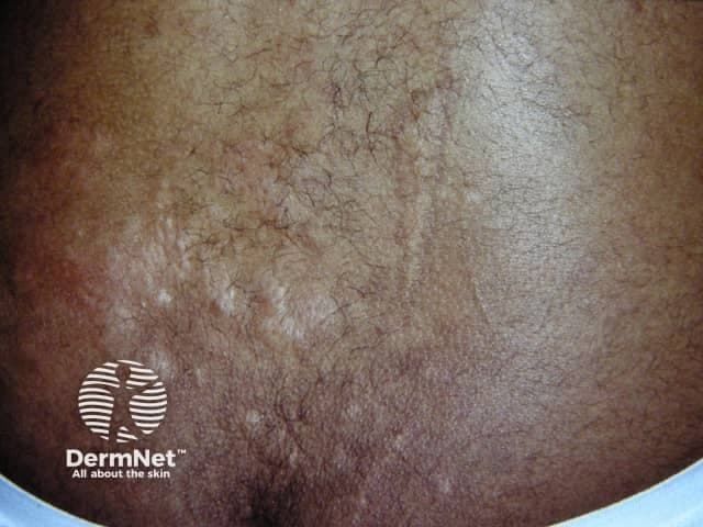 Clinical photography of a cutaneous Shagreen patch in a patient with tuberous sclerosis complex. Modality: color digital photography, noninvasive in vivo imaging of the trunk skin, most often the lumbosacral region. The patch appears as a localized, slightly raised, leathery plaque with a coarse, pebbled surface and fine reticulate skin markings. The coloration is variably hyperpigmented to brown, with subtle border irregularity and diffused beveling of surrounding skin. Histological correlation would show a dense, thickened dermal collagen network with relative paucity of elastic fibers, giving a firm, taut texture. Clinically, shagreen patches are among the major diagnostic criteria for TSC and serve as a visible surrogate marker of underlying systemic involvement. They commonly arise on the trunk, especially the lumbosacral region, and may co-develop with hypomelanotic macules, facial angiofibromas, and cortical/subependymal lesions. Differential diagnosis includes morphea, elastosis perforans serpiginosa, and other pigmented or sclerotic dermatoses. The diagnostic significance lies in reinforcing the suspicion of tuberous sclerosis and prompting targeted MRI brain, renal ultrasound, and cardiac surveillance. This image is relevant for dermatology, medical education, and radiology-pathology correlation studies, illustrating cutaneous stigmata that guide multidisciplinary evaluation and management in pediatric and adult patients with TSC. for differential diagnosis and research.