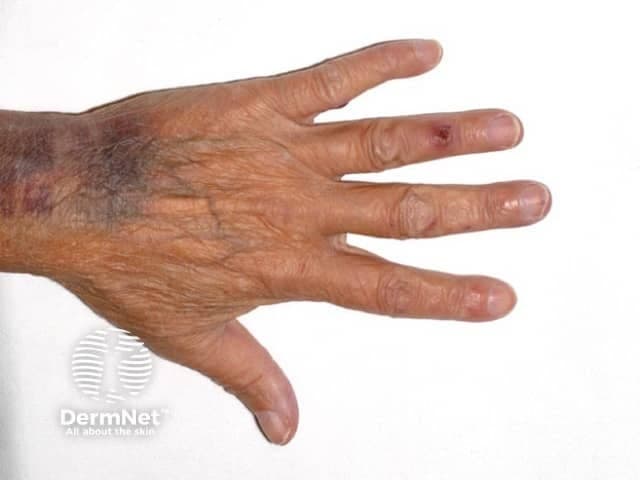 Clinical photography of a human hand highlighting digital Osler nodes associated with infective endocarditis. Modality: clinical photograph; perspective: dorsal hand view with fingers extended to expose distal finger pads. The ring finger bears a localized tender subcutaneous nodule at the fingertip/pulp, with additional subtler nodules on the adjacent middle and little fingers. The nodules are erythematous to violaceous, slightly raised, and may be palpably firm; surrounding skin appears otherwise unremarkable apart from subtle venous markings and age-related signaling. This image documents cutaneous manifestations that support a diagnosis of infective endocarditis in the appropriate clinical context. Osler nodes (Osler’s nodules) are immune-complex–mediated microvasculitis presenting as painful nodules on the digits; they contrast with Janeway lesions, which are usually painless. Clinically relevant features include tenderness, localized swelling, and distal finger involvement. The photograph is useful for education about dermatologic findings in infectious diseases and for medical-legal documentation of exam signs. In a patient with fever, new heart murmur, or positive blood cultures, these lesions increase pretest probability of infective endocarditis and guide downstream evaluation, including echocardiography and serology. Differential and educational use cases include distinguishing infectious endocarditis cutaneous signs from rheumatoid nodules, gouty tophi, or from digital trauma. Educational reference for clinicians.