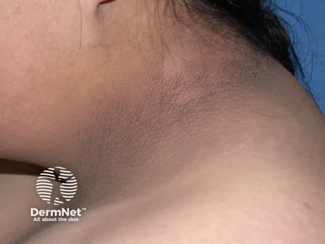 Clinical photography of the neck demonstrates acanthosis nigricans: hyperpigmented, velvety plaques within intertriginous regions of the cervical skin. The image shows a brown-to-dark brown, slightly pigmented area along the posterior and lateral neck folds, with smooth but thickened dermal-epidermal junction and papillomatosis consistent with acanthosis nigricans. The texture appears velvety on close inspection, and the surrounding skin remains comparatively lighter. There is no visible mucosal involvement or ulceration. The pattern is typically bilateral and symmetric, favoring the neck and adjacent flexural areas; extension to axillae or inguinal folds may be observed in some patients. This dermatologic finding is commonly associated with insulin resistance, obesity, type 2 diabetes mellitus, endocrine disorders, or, in rare adults, paraneoplastic syndromes. Clinically, acanthosis nigricans serves as a cutaneous sign prompting assessment of metabolic health, including fasting glucose, HbA1c, lipid profile, and weight management. The image is intended for educational purposes to illustrate morphological features such as hyperpigmentation, velvety texture, and intertriginous distribution; it aids differential diagnosis including frictional hyperpigmentation and postinflammatory changes. Potential uses include dermatology training, primary care screening, and research on metabolic disease correlations. Limitations: single-view photograph cannot assess texture depth or extent; clinical history crucial for confirming etiologies and guiding management decisions.