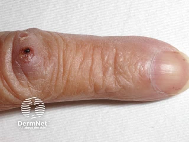 This clinical photograph documents a lateral view of the index finger with visible cutaneous signs of infective endocarditis. The primary subject is dermatologic manifestations: Osler nodes—tender, subcutaneous nodules located at the fingertip/distal phalanx region—alongside splinter hemorrhages beneath the nail plate. The image demonstrates a small, dark lesion near the fingertip base and tiny linear reddish-brown streaks under the nail plate. The surrounding skin shows mild edema and inflammatory changes. These findings are classic for subacute bacterial endocarditis and immune complex–mediated vasculitis. Diagnostic significance: Osler nodes indicate immune-complex deposition in the dermis with concurrent bacteremia and endocardial infection; splinter hemorrhages reflect distal microemboli or microvasculopathy. Differential considerations include Janeway lesions (painless), rheumatoid nodules, vasculitic lesions, or trauma-related changes. Clinical correlation: chest auscultation may reveal a cardiac murmur; blood cultures and inflammatory markers (CRP, ESR) may be positive; treatment decisions rely on echocardiography and microbiology. Imaging modality: clinical photography using a digital camera; technique: macro/close-up; lighting: natural or diffused; magnification: not specified. Anatomical location: distal phalanx of the index finger, fingertip pad; laterality: not specified; anatomical plane: lateral/volar aspect. Use cases: bedside assessment, educational dermatology and internal medicine, documentation of endocarditis signs.