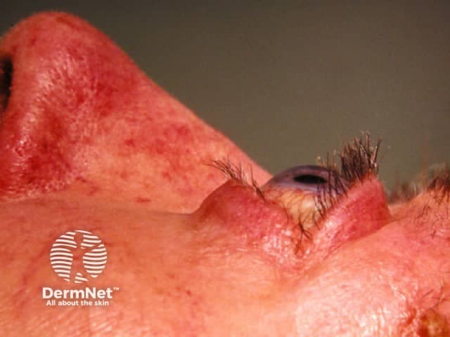 This clinical photograph is a high-resolution, lateral oblique view of the periocular region focusing on the right eye (periorbital skin). The image demonstrates marked periorbital edema with pronounced erythema of the eyelids and surrounding cutaneous tissue. The upper and lower eyelids appear swollen and thickened, with subtle skin redundancy. In thyroid-associated ophthalmopathy (Graves' orbitopathy), this presentation reflects inflammatory edema of orbital tissues, increased adipose and extraocular muscle volume, and skin involvement. The visible periorbital edema may precede or accompany exophthalmos, lid retraction, and diplopia; however, soft tissue contour is partially obscured by lighting. The photo lacks palpation data but serves as a qualitative depiction of orbital involvement. Clinically, these features require correlation with systemic thyroid status: hyperthyroidism or euthyroid Graves' disease; presence of TSH receptor autoantibodies; risk of progressive-eye involvement. This image supports differential diagnosis including periorbital cellulitis and dermatitis, but the chronic inflammatory pattern aligns with thyroid eye disease. For diagnostic significance, the image is valuable for medical education, patient counseling, and multidisciplinary planning—endocrinology, ophthalmology, and dermatology collaboration. Potential clinical use cases include screening for orbital involvement in Graves' disease, documenting disease progression, and teaching residents about periorbital edema etiologies and differential diagnoses.