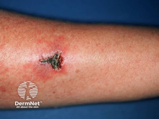 Clinical photography of a solitary forearm lesion demonstrates an irregular ulcer with a dark necrotic crust and surrounding erythema. The image depicts cutaneous involvement that can accompany eosinophilic granulomatosis with polyangiitis (Churg-Strauss syndrome), a small-vessel vasculitis characterized by eosinophilic infiltrates and granulomatous inflammation. Visual features include a punched-out appearance, eschar formation, and a tender, inflamed rim. This macroscopic dermatologic finding is non-specific but clinically significant when integrated with systemic symptoms such as asthma, eosinophilia, neuropathy, and vasculitic organ involvement. The diagnostic value lies in documenting skin involvement, guiding biopsy targeting, and assisting differential diagnosis against leukocytoclastic vasculitis, pyoderma gangrenosum, infectious ulcers, or other cutaneous vasculitides. In clinical practice, this image would be used in dermatology, rheumatology, and pathology workflows to correlate histology with morphology, monitor treatment response, and educate learners about cutaneous manifestations of EGPA and related eosinophilic vasculitides. These attributes enhance cross-disciplinary teaching, case-based learning, and AI-enabled retrieval in diagnostics practice.