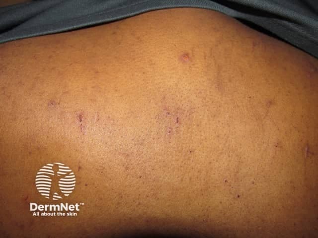 Clinical photography of cutaneous lesions on the back (posterior trunk). The image captures multiple tiny non-blanching petechiae and purpuric macules scattered across the thoracic–lumbar region. Lesions are discrete, punctate to 2–4 mm, flat, with a violaceous to brownish hue and no evident central necrosis or blistering. Some clusters appear confluent, forming larger patchy areas along relaxed skin folds. The surrounding skin shows mild textural variation but no significant edema. The overall pattern is asymptomatic in appearance, with lesions primarily in exposed or pressure-prone zones, suggesting superficial dermal hemorrhage without epidermal disruption. This appearance corresponds to purpura/petechiae rather than wheals or vesicles. Pathophysiologically, extravasation of red blood cells into the dermis produces the characteristic color change; lesion size and distribution can reflect microvascular fragility, thrombocytopenia, vasculitis, or coagulopathy. Clinically, the finding prompts correlation with systemic signs (fever, mucosal bleeding, fatigue) and complete blood count, coagulation studies, and review for medications or infectious etiologies. Differential diagnoses include benign frictional petechiae, senile purpura, drug-induced purpura, and inflammatory vasculitis. This image is valuable for dermatology education, triage training, and research on cutaneous hemorrhagic patterns; it supports teaching about diagnostic workup, documentation, and pattern recognition in pigmentary and vascular skin disorders. Educational, clinical, and research.
