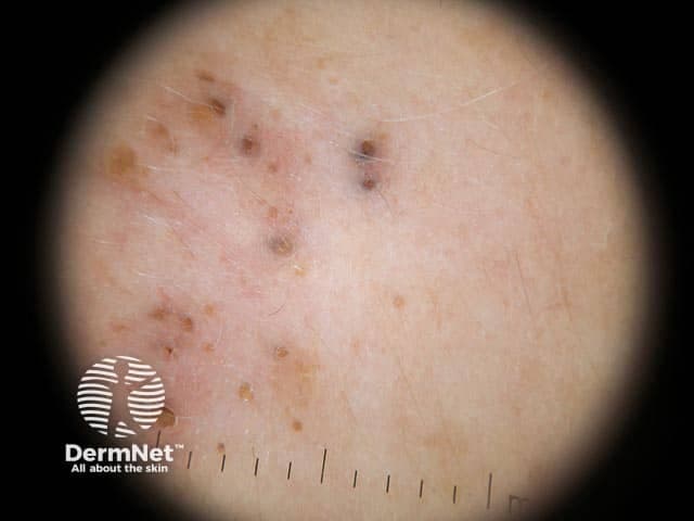 High-resolution dermoscopy of sun-exposed facial skin reveals multiple open, keratin-filled follicular openings consistent with solar comedones. The individual plugs appear as rounded to oval, yellow to brown structures embedded within comedone-like follicles, often surrounded by a lightly erythematous or pale epidermis. The background demonstrates photodamage markers such as fine telangiectasia and subtle actinic elastosis, with reduced skin elasticity. Notably, there is an absence of prominent vascular structures within the plugs, and inflammatory signs are minimal or absent, helping distinguish these lesions from acne vulgaris. The keratin plugs may coalesce into clusters or align along follicular openings, producing a nonuniform topography across the scanned field. Under dermoscopy, these features correlate with chronic ultraviolet exposure and degenerative changes in pilosebaceous units. The image is diagnostic for solar comedones and supports a broader Favre-Racouchot spectrum when accompanied by extensive actinic damage. Clinically, this finding underscores photodamage rather than infectious or neoplastic processes. Diagnostic significance lies in differentiating from actinic keratosis or pigmented lesions in sun-damaged skin. Potential differential diagnoses include open comedones of acne, keratin-filled follicles, and rare follicular tumors. Management emphasizes sun protection, regular surveillance, and keratolytic or exfoliating therapies as appropriate. Educational use: clinicopathologic correlation and photodamage grading for teaching purposes.