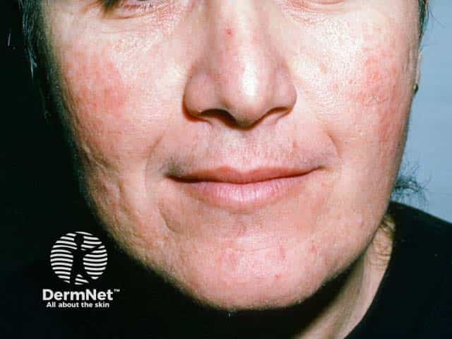 Clinical dermatology photograph of the face, frontal view, documenting steroid-induced rosacea involving the malar (cheek) and chin regions. Modality: clinical digital photography; technique: standardized facial lighting, color-balanced imaging; specimen: human skin; view: anterior facial aspect. Anatomical context: integumentary system; facial skin on the central face, cheeks (malar regions) and chin, bilateral distribution, anterior plane. Visual features: diffuse erythema with fine papules and minimal pustulation, subtle perifollicular accentuation, and mild visible telangiectasia in the affected zones; skin texture appears slightly roughened with reactive hyperemia; absence of comedones or nodular infiltration in this frame. Diagnostic implication: fits steroid-induced rosacea spectrum rather than classic acne vulgaris; triggers include potent topical corticosteroids; history of recent steroid use would corroborate; differential diagnoses include acne rosacea, steroid dermatitis, perioral dermatitis, contact dermatitis. Clinical significance: highlights adverse cutaneous effect of topical steroids, guides management (withdrawal or taper, barrier repair, anti-inflammatory strategies, calcineurin inhibitors, non-irritant skincare, photoprotection). Potential clinical use cases: educational reference for dermatology training, case-based learning on iatrogenic rosacea, monitoring response to withdrawal therapy, decision support for treatment planning, and aiding patient counseling about steroid safety and rosacea flares. This image supports standardized documentation, teaching symptom recognition, and guiding patient-tailored stop-start therapy.