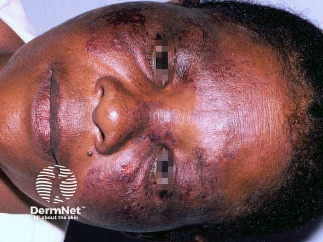 Clinical photograph of a middle-aged adult male presenting with facial steroid-induced rosacea and postinflammatory hyperpigmentation. Modality: Clinical photography; frontal view of the face under diffuse, non-diagnostic lighting. The centrofacial skin shows diffuse erythema with prominent telangiectasia, especially on the cheeks and nose. Superimposed papules and few pustules are evident around the nasolabial folds and forehead, with patchy hyperpigmented macules on the malar regions. The perioral area may be involved, and there is mild edema and skin fragility consistent with steroid-related epidermal thinning. Bilateral distribution is noted, with involvement of forehead, cheeks, and perioral skin. This pattern is characteristic of topical corticosteroid overuse leading to an inflammatory rosaceiform eruption rather than classic acne. The clinical diagnosis is steroid-induced rosacea with pigmentary changes; histopathology is not provided. Diagnostic significance includes recognizing steroid-related dermatosis to prevent progression and guide withdrawal and treatment. Differential diagnoses include rosacea (non-steroid–associated), acne vulgaris, perioral dermatitis, and dermatitis from irritants. Clinical correlation should focus on patient history of potent facial steroid use, duration, and taper strategy. This image is educational for dermatology training, medical education, and AI-assisted lesion recognition, highlighting pigmentary complications and telangiectasia in centrofacial dermatoses. Clinically, cessation of potent steroids is essential.