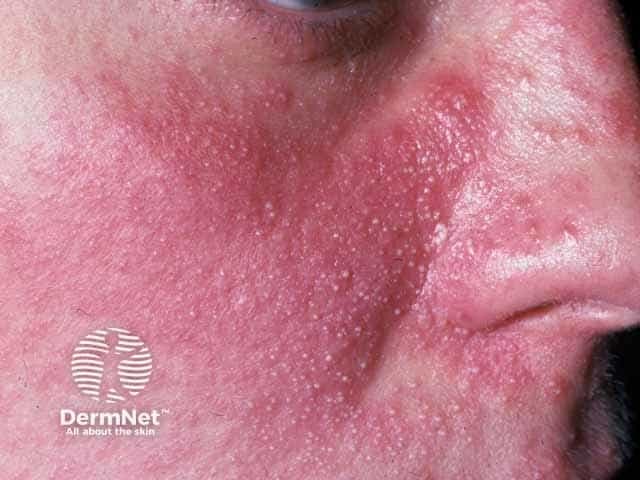 This is a high-resolution clinical dermatology photograph of the lateral left midface (cheek, nasal bridge and perioral region) captured in a frontal-oblique view to document steroid-induced papulopustular rosacea (SR). modality: in vivo skin photography; technique: standard color photography under diffuse, clinical lighting. The image shows diffuse facial erythema with numerous small papules and pustules scattered across the central face, involving cheeks and nasal ala, with mild edema and fine scaling. The papules are 1–3 mm, some pustular, follicular-based, with perifollicular erythema indicating inflammatory papulopustular eruption. There is no obvious comedones; telangiectasias may be subtle. The distribution pattern is centralized rather than peripheral; appearance may reflect steroid-exacerbated rosacea or rosacea-like dermatitis following topical corticosteroid use. Noting steroid history is critical to differentiate from acne vulgaris. Management implications include cessation of offending steroid, initiation of rosacea-directed therapy (metronidazole, azelaic acid, ivermectin, doxycycline in appropriate doses) and patient education on steroid-sparing regimens. This image is valuable for educational comparisons with acneiform eruptions and rosacea phenotypes, supports differential diagnosis, and monitors treatment response in SR-patient cohorts. Clinical utility includes documenting response to therapy, guiding patient counseling, and enabling comparative studies of steroid-induced rosacea across patient cohorts and dermatology education programs for clinical learning purposes.