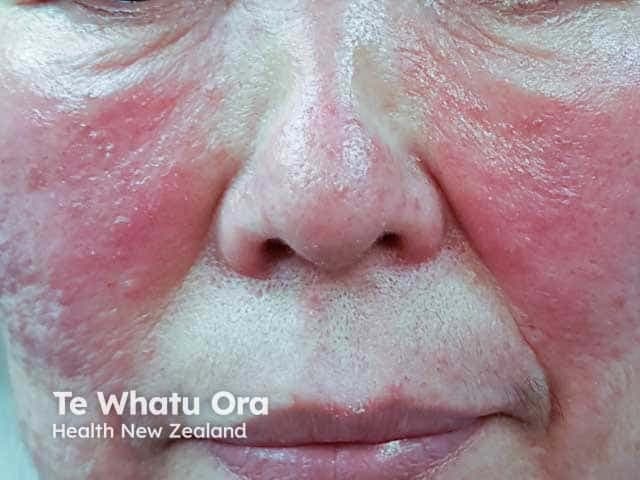 Modality and technique: high-resolution clinical photography of the face in frontal/anterior view, providing a close-up assessment of cutaneous inflammation. Anatomical focus: central facial skin encompassing the nasal dorsum, cheeks, nasolabial folds, and perioral region. Observed features: uniform facial erythema with prominent edema, particularly on the malar cheeks and nasal pyramid, accompanied by discrete papules and pustules within inflamed erythematous areas. The texture appears smooth to slightly glossy, with diffuse vascular blush and minor swelling around the nose and midface. The pattern is bilateral and symmetrical, consistent with steroid-induced rosacea (SR), a dermatosis precipitated by topical or systemic corticosteroid exposure. Differential considerations include acne rosacea, perioral dermatitis, dermatitis medicamentosa, and contact dermatitis; however, the history of steroid use and the central facial predominance favor SR. Pathophysiology involves disruption of pilosebaceous unit homeostasis and steroid-induced telangiectasia, leading to papulopustular flares. Clinical significance lies in the need to discontinue the offending steroid, initiate rosacea-appropriate therapy (e.g., metronidazole, doxycycline, brimonidine), and monitor for rebound flaring. Potential clinical uses include documenting treatment response, educating patients, and supporting differential diagnosis in photodermatology and cosmetic dermatology. This image exemplifies central facial inflammation with papulopustular lesions in SR. Interpretation aids patient counseling and targeted management planning for clinicians.