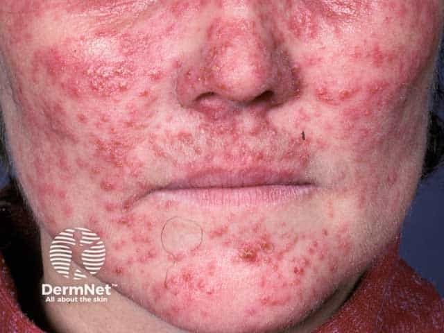 Clinical photography of an adult's face showing a diffuse erythematous papulopustular eruption consistent with steroid-induced rosacea. Modality: Clinical photography; anterior facial view. The cheeks, nasal bridge, perioral regions are symmetrically involved with diffuse erythema and scattered inflamed papules and pustules; mild edema and telangiectasia may be present but not clearly visible. Anatomical regions include the malar and nasolabial areas. The eruption reflects inflammatory infiltration of the epidermis and superficial dermis with vascular dilation. Pathophysiology likely relates to prolonged topical corticosteroid suppression of innate immunity and induction of vasodilation leading to rosacea-like eruption; withdrawal and gradual tapering of steroids are essential. Differential diagnoses include acne rosacea, acne vulgaris, perioral dermatitis, seborrheic dermatitis, and contact dermatitis. Diagnostic significance: steroid-induced facial rosacea is typically reversible with appropriate management after identifying and stopping the offending agent, though lingering erythema may persist. Clinical use cases include educational demonstration, differential diagnosis training, and guiding management decisions. The image supports recognition of steroid-induced rosacea patterns, informs patient counseling on prognosis, and assists in planning skin barrier restoration and anti-inflammatory therapy. High-quality color fidelity and standard lighting enhance lesion visualization for teaching and remote consultation. This description emphasizes morphological details such as papules, pustules, and diffuse erythema present.