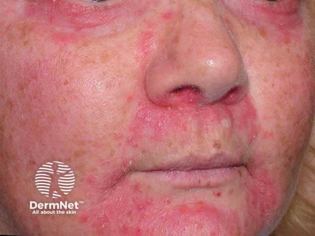 This is a frontal clinical photograph of an adult patient’s face illustrating steroid-induced facial rosacea with perioral dermatitis. Modality: Digital color photography, in vivo, captured under standard indoor lighting with routine color balance. Anatomical region: central face including cheeks, nasal area, perioral region and adjacent perinasal skin. The image shows diffuse erythema with a prominent papulopustular eruption, fine scaling, and subtle telangiectasia across the malar cheeks and nasal bridge, extending around the mouth. Bilateral distribution is evident, with accentuation along the nasolabial folds and perioral zone. Palpebral and eyelid skin not clearly involved. The lesions are small to moderate in size, with confluent erythematous patches interspersed by discrete papules and pustules; surface texture appears tender and mildly edematous. Clinically, the appearance is characteristic of corticosteroid-related facial dermatitis, specifically steroid-induced rosacea and perioral dermatitis, often resulting from recent or prolonged topical corticosteroid use. Diagnostic significance: history of steroid exposure with paradoxical facial inflammation; differential includes rosacea not steroid-related, acneiform dermatitis, seborrheic dermatitis, and contact dermatitis. Clinical correlation: cessation of potent steroids, gradual taper, and initiation of appropriate dermatologic therapy typically yield gradual improvement over weeks to months. Potential clinical use: education, documentation, disease monitoring, AI-training datasets for dermatology.