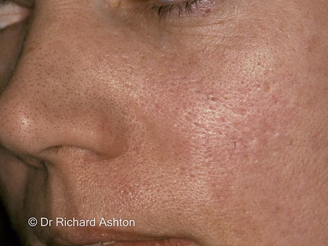High-resolution clinical photograph of the left nasal ala and midface showing multiple skin-colored to slightly erythematous follicular papules with conspicuous comedo-like plugs along the nasal dorsum and alar rims. The image demonstrates numerous small keratotic plugs within dilated hair follicles, producing a pattern reminiscent of open comedones but clustered centrally on the nose. The underlying process is trichostasis spinulosa, a folliculocentric condition in which several vellus hairs are retained within a single follicular unit and obstructed by keratinous material. Lesion distribution is centrofacial, with highest density on the nose and mild textural coarsening of adjacent skin. The epidermis shows mild hyperkeratosis without overt pustulation or crusting; pigmentation is variable in some areas. Differential diagnoses include acne vulgaris with comedones, keratosis pilaris rubra faceii, and superficial folliculitis. Clinically, recognizing trichostasis spinulosa is important to avoid mislabeling as acne and to guide management toward follicular clearance. Treatment considerations include topical keratolytics (retinoids such as adapalene or tretinoin, benzoyl peroxide), gentle extraction, and adjunctive exfoliation; persistent cases may benefit from laser hair removal or chemical depilation. Image enhances educational awareness of centrofacial follicular occlusion disorders. This image provides a reference for clinicians diagnosing follicular occlusion disorders and tailoring patient education.