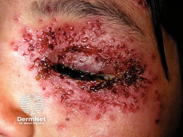 This clinical photograph shows a severe periorbital eruption in a patient with dermatitis, clinically consistent with eczema herpeticum (Kaposi varicelliform eruption). The image is a frontal close‑up of the left periorbital skin with numerous vesicles, pustules, and crusted erosions surrounding the eyelid margin and adjacent cheek. The involved skin is erythematous and edematous, with moist surfaces and dark hemorrhagic crusts. Vesicles have coalesced into crusted plaques and the ocular adnexa appear threatened by surface breakage, increasing risk of keratoconjunctivitis. The presentation reflects acute HSV infection superimposed on underlying atopic dermatitis or eczema, a pattern that can mimic impetigo or other bacterial dermatitis but is distinguished by vesiculopustular morphology and rapid crusting. Diagnostic considerations include HSV or other herpetic viruses; bacterial superinfection; varicella; and, less commonly, dermatitis herpetiformis is not typical. Clinical significance is high due to potential ocular involvement and systemic risk; urgent antiviral therapy and broad-spectrum antibiotics if secondary infection are considered. This image serves as a teaching example for dermatology, infectious disease, and ophthalmology contexts, illustrating periorbital HSV eruption on compromised skin, and highlighting the importance of early recognition, swab PCR confirmation, and prompt management to prevent complications. Further documentation should include sequential photographs documenting lesion evolution carefully.