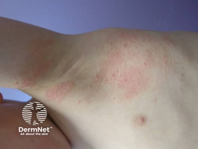 Imaging modality: Clinical photography of dermatologic lesions using color digital capture. The subject is in vivo skin on the forearm/elbow region. The view shows multiple small, discrete, dome-shaped papules ranging 2–5 mm in diameter. Lesions are pink to flesh-colored with a subtle sheen. Several papules appear slightly umbilicated, a classic feature of Molluscum contagiosum; the surface is smooth with minimal scaling or crusting. The distribution is localized to the extensor forearm without extensive involvement of other sites in this image. The epidermis over the lesions is mildly elevated, and the surrounding skin shows dermatitis-like redness, which can accompany secondary irritation.

Molluscum contagiosum is a poxvirus-induced dermal infection commonly seen in children but also in adults, transmitted by direct contact or shared items. The image depicts typical clinical morphology: pearly to flesh-toned papules with central indentation and mild erythema. Imaging alone is not diagnostic; histopathology would show molluscum bodies within keratinocytes. Clinically, the diagnosis is supported by autoinoculation and spread pattern, especially in immunocompromised individuals. Differential considerations include viral warts (HPV), folliculitis, and spongiotic dermatitis. Management ranges from observation for spontaneous resolution to destructive therapies such as curettage, cantharidin, and cryotherapy, with infection control and cosmetic considerations. This image serves as a reference for recognition, tele-dermatology triage, and differential diagnosis practice.
