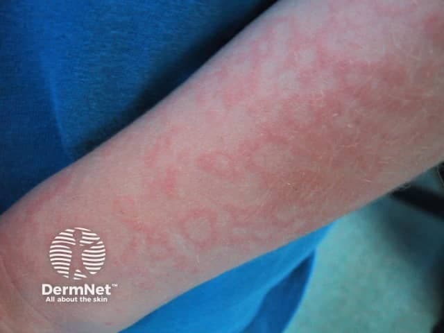 This clinical photograph depicts a skin eruption consistent with erythema infectiosum (fifth disease) on the forearm. Imaging modality: clinical photography in standard color profile; single anterolateral forearm view. The rash shows a fine, lacy or reticular erythema pattern distributed along the skin surface; pink to light red coloration with mild blanching on palpation. The epidermis is uninvolved to mildly accentuated by vascular dilation; there is no vesiculation or necrosis. The lesion tracks a superficial dermal capillary network, producing a net-like appearance that is more conspicuous in lighter skin tones. The pattern may begin subtely and intensify during febrile illness, then evolve to a reticular exanthem that spares the face early in disease. In erythema infectiosum, parvovirus B19 infection is the etiologic agent; the clinical correlation includes low-grade fever, malaise, and sometimes pruritus. Differential considerations include other viral exanthems (rubella, roseola), pityriasis rosea, drug eruption, and contact dermatitis. The diagnostic significance lies in recognizing the lace-like rash in children, which is typically self-limited and resolves without scarring within days to weeks. This image is relevant for dermatology education, infectious disease references, and clinical case repositories focusing on pediatric exanthems and viral rash patterns. Image assists in differential diagnosis and education globally.