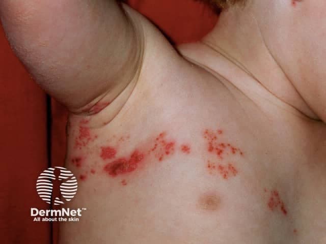 Clinical dermatology photograph of a pediatric patient shows an acute vesicular rash consistent with herpes zoster (shingles) in a dermatomal distribution along the left thorax/axillary region. The image demonstrates clustered vesicles on an erythematous base with surrounding mild edema and crusted lesions at several sites. Lesions appear arranged in a band-like pattern corresponding to a single spinal or cutaneous nerve dermatome, with unilateral involvement typical of varicella-zoster virus reactivation. The skin appears otherwise uninvolved beyond the affected dermatomes, and there is no obvious mucosal involvement in this view. Close-up, high-resolution photography captures the lesion morphology: discrete vesicles, some coalescing papules, thin crusts, and surrounding erythema. No purpura or ulceration is evident. The modality is noninvasive clinical photography, using standard illumination and close frontal view to document surface morphology without contrast or biopsy. Clinically, this image is relevant for differential diagnosis and educational discussions of zoster in children, including timing of antiviral therapy, pain management, and vaccination considerations. The finding's diagnostic significance lies in the dermatomal distribution, vesicular morphology, and temporal progression, aiding differentiation from disseminated varicella, contact dermatitis, and herpes simplex infection. Potential clinical uses include triage, medical education, and research on pediatric VZV reactivation patterns.