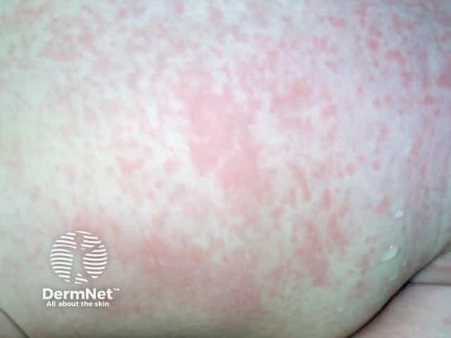 Dermnetnz