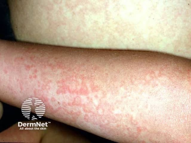 Clinical photography, dermatology assessment of a forearm reveals a lace-like, reticular erythematous rash consistent with Fifth disease (erythema infectiosum) due to parvovirus B19. The image shows a close-up, high-resolution view of cutaneous vascular dilation forming a net-like pattern across the affected skin with fine blanching and even distribution. Surface integrity remains preserved, with flat, non-vesicular erythematous patches that accentuate the interlacing lines. This dermatosis classically occurs in children and can accompany mild fever or malaise; in many cases facial erythema (slapped cheeks) is prominent, though not always visible in a limb-focused photograph. The rash tends to appear on the trunk and proximal limbs and may spare mucosa. Resolution is typically spontaneous within 1–3 weeks, with possible mild pigmentary after-effects. Clinically, the image supports recognition of a viral exanthem with the characteristic reticular pattern, assisting in differential diagnosis from pityriasis rosea, rubella, roseola, drug eruptions, and other viral exanthems. Parvovirus B19 serology or PCR can confirm infection if clinical suspicion is high. This image is valuable for education in pediatric dermatology, infectious disease, and primary care, enabling pattern-based learning, case-based discussion, and image database curation. High-quality imaging enhances diagnostic confidence and education, especially useful for telemedicine and remote consultation.