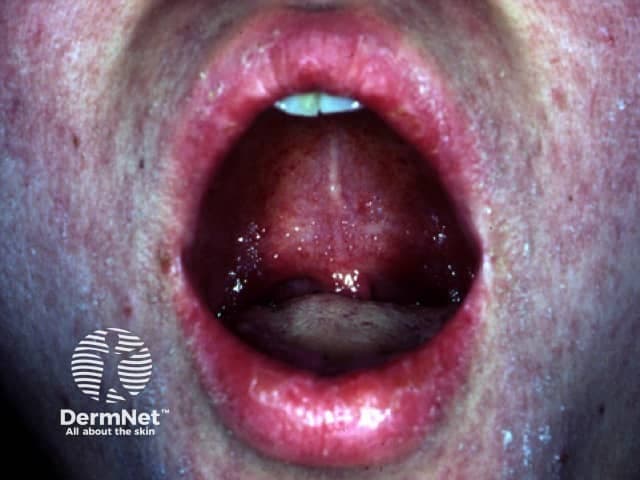 Clinical photograph of the oral cavity showing Koplik spots, a classic mucosal manifestation of measles. Modality: Clinical photography; technique: intraoral close‑up of the buccal mucosa. Location: buccal mucosa near the molar teeth, on an erythematous background. Visual features: numerous small, discrete, bluish‑white to white centers surrounded by red mucosa; lesions measure approximately 1–3 mm in diameter and may appear vesicular or punctate. The mucosa surrounding the spots is inflamed and moist, with mild hyperemia and glossed surfaces in this region. Significance: Koplik spots are highly suggestive of acute measles infection, often appearing during the prodromal phase before the maculopapular rash; they are considered pathognomonic when present. Pathology: viral cytopathic changes in the oropharyngeal epithelium with focal desquamation; clinically, the finding helps confirm a diagnosis of measles in the appropriate clinical context. Diagnostic significance: supports presumptive diagnosis of measles; prompts public health actions, isolation, and antiviral/public health precautions. Differential considerations include aphthous ulcers, herpangina, other viral exanthems, or mucosal lesions in systemic illness, though Koplik spots possess a distinctive bluish center on erythematous mucosa. Clinical correlation: correlate with fever, cough, coryza, conjunctivitis, and rash onset. Utility: educational for clinicians, nurses, medical/dental students; aids recognition and differential diagnosis of febrile rash illness.