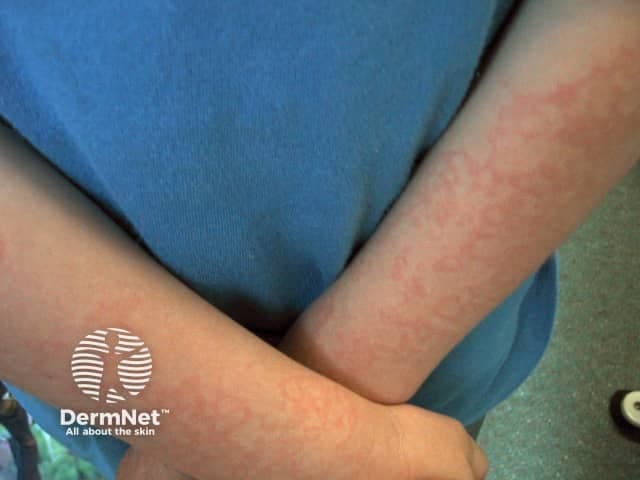 Clinical photography of a young child’s forearms showing a diffuse, erythematous, maculopapular eruption. The image captures bilateral antebrachial surfaces in a frontal/anterior view with natural color balance and close-up framing suitable for dermatologic assessment. Lesions are red plaques and spots, some confluent into larger patches, with well-defined but irregular borders and no evident vesiculation or purpura. Surface texture appears smooth to mildly raised; there is no obvious crusting or scale in the visible areas. The distribution is bilateral and primarily involves extensor aspects of the forearms, though involvement of other exposed areas cannot be excluded from the single view. The overall appearance is nonspecific but consistent with common pediatric inflammatory eruptions. Potential etiologies include atopic dermatitis (eczema), contact dermatitis, acute urticaria, and viral exanthem; less likely considerations include drug eruption and less common autoimmune or infectious conditions. Clinically, this image emphasizes the importance of history (onset, fever, itch, exposures) and examination of adjacent skin and mucosa. For diagnostic planning, correlate with trunk and face skin, assess pruritus intensity, and review recent medications and illnesses. High suspicion for reactive dermatitis guides initial management with barrier protection, gentle emollients, and targeted topical therapy as indicated.