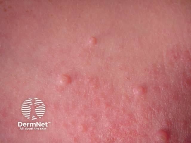 This is a clinical dermatology photograph illustrating Molluscum contagiosum. Modality and technique: clinical photography; perspective: close-up, surface view of the skin. Anatomical context: cutaneous epidermis, likely trunk or extremities. The image shows multiple small, discrete, dome-shaped papules, 2–5 mm in diameter, with smooth, slightly shiny surfaces and a central umbilication. Lesions are flesh-colored to pale pink against normal skin; surrounding skin may be mildly erythematous in susceptible individuals. Papules appear clustered in groups, consistent with localized contagion and autoinoculation. There is no crusting, scaling, vesiculation, or pustulation evident. Overall, the pattern is highly suggestive of molluscum contagiosum, a benign poxvirus infection. If histology were obtained, one would expect Henderson-Patterson bodies within keratinocytes. Clinically, molluscum presents as painless, pearly, umbilicated papules, most common in children but also seen in adults with atopy or immunosuppression. Differential considerations include verruca vulgaris, epidermal inclusion cysts, milia, syringomas, and folliculitis; central umbilication helps distinguish molluscum. Clinical significance: contagious via direct contact and fomites; usually self-limited but treated in persistent or symptomatic cases. This image is suitable for dermatology education, visual diagnosis training, pediatric skin disease curricula, and clinical decision support. Endemic in many regions; consider screening for other pediatric skin infections.