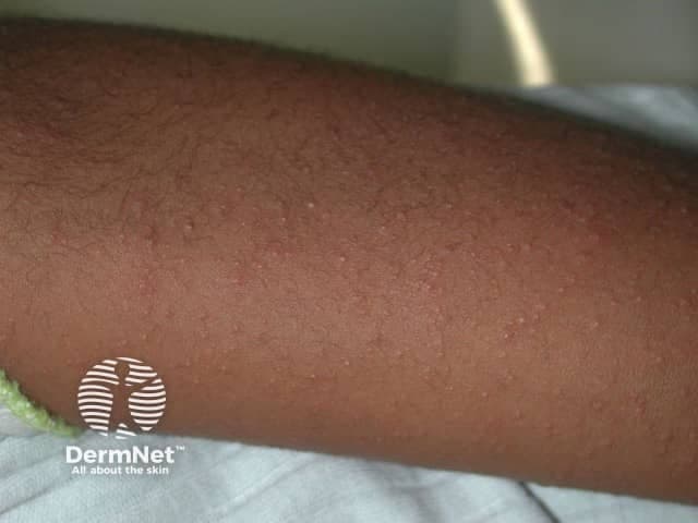 Imaging modality: Clinical photography of cutaneous surface. The image shows a close-up, anterior forearm view with diffuse, erythematous papules arranged in a maculopapular pattern. Lesions are small (roughly 1–3 mm), non-vesicular, non-follicular, and slightly raised, with even distribution across the exposed skin. The surrounding skin demonstrates a uniform complexion with no necrosis or purpura. Lighting is diffuse and neutral, suitable for dermatologic photography; no magnification or dermatoscopic features are evident. The findings are consistent with a viral exanthem—a contagious, self-limited dermatologic eruption seen in primary viral infections. The pattern is nonspecific but typical of pediatric viral illnesses and presents as a diffuse rash that may accompany fever or systemic symptoms. Potential etiologies include measles (rubeola), rubella, roseola (exanthem subitum), parvovirus B19, enteroviruses, and adenovirus infections. Clinically, the exanthem may precede or follow other signs such as cough, conjunctivitis, pharyngitis, lymphadenopathy, or malaise. Diagnostic significance lies in correlating clinical history, vaccination status, exposure risk, and evolution of the rash; laboratory tests or serology can aid confirmation when indicated. Differential considerations encompass drug eruption and pityriasis rosea. This image is valuable for dermatology education and clinical exemplars of viral rashes.