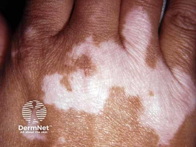Clinical photography of a dorsal hand demonstrating vitiligo with Koebnerization on knuckle skin. The image displays several well-defined, milky white depigmented macules and patches over the dorsal metacarpophalangeal and interphalangeal regions, with sharp, irregular margins and no scale or erythema. Peripheral skin is variably hyperpigmented, creating a contrasted patchwork appearance. The lesions coalesce in places, forming larger depigmented areas that highlight focal loss of pigmentation rather than true hypopigmentation. The clinical context suggests Koebner phenomenon, where traumatic microinjury to the skin (e.g., friction on knuckles) triggers new depigmented plaques in susceptible individuals. This pattern is characteristic of vitiligo, an autoimmune pigmentary disorder driven by melanocyte destruction with loss of epidermal melanocytes and melanin pigment. The image is not of histology or radiology; it is a gross dermatologic photograph; no staining or contrast used. Relevance: aids diagnosis of vitiligo and Koebnerization, guides patient counseling, photoprotection, and potential systemic evaluation for associated autoimmune conditions (thyroid disease, type 1 diabetes). In differential diagnosis, consider tinea versicolor, postinflammatory hypopigmentation, and less likely leprosy or pityriasis alba. The photo supports educational demonstrations of lesion morphology, distribution, and the Koebner response in pigmentary disorders. High-contrast images enhance recognition of margins and sparing of surrounding pigmented skin.